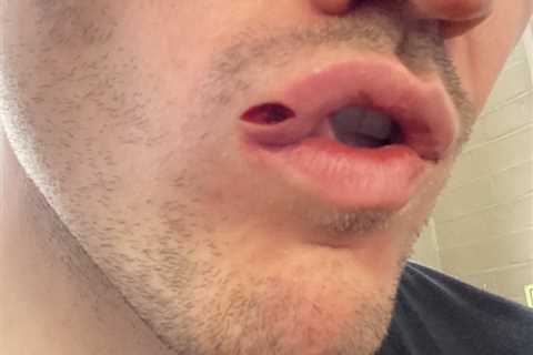 Shane McGuigan shows off gruesome split lip which requires stitches after being punched in face by..