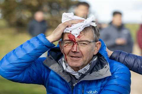 Spectator Left Bloodied After Being Hit by Golf Ball at Dunhill Championship